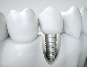 Model of dental implant